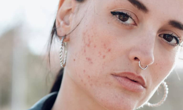 Erre h&iacute;vj&aacute;k fel a figyelmet a pattan&aacute;sok az arc k&uuml;l&ouml;nb&ouml;ző r&eacute;szein